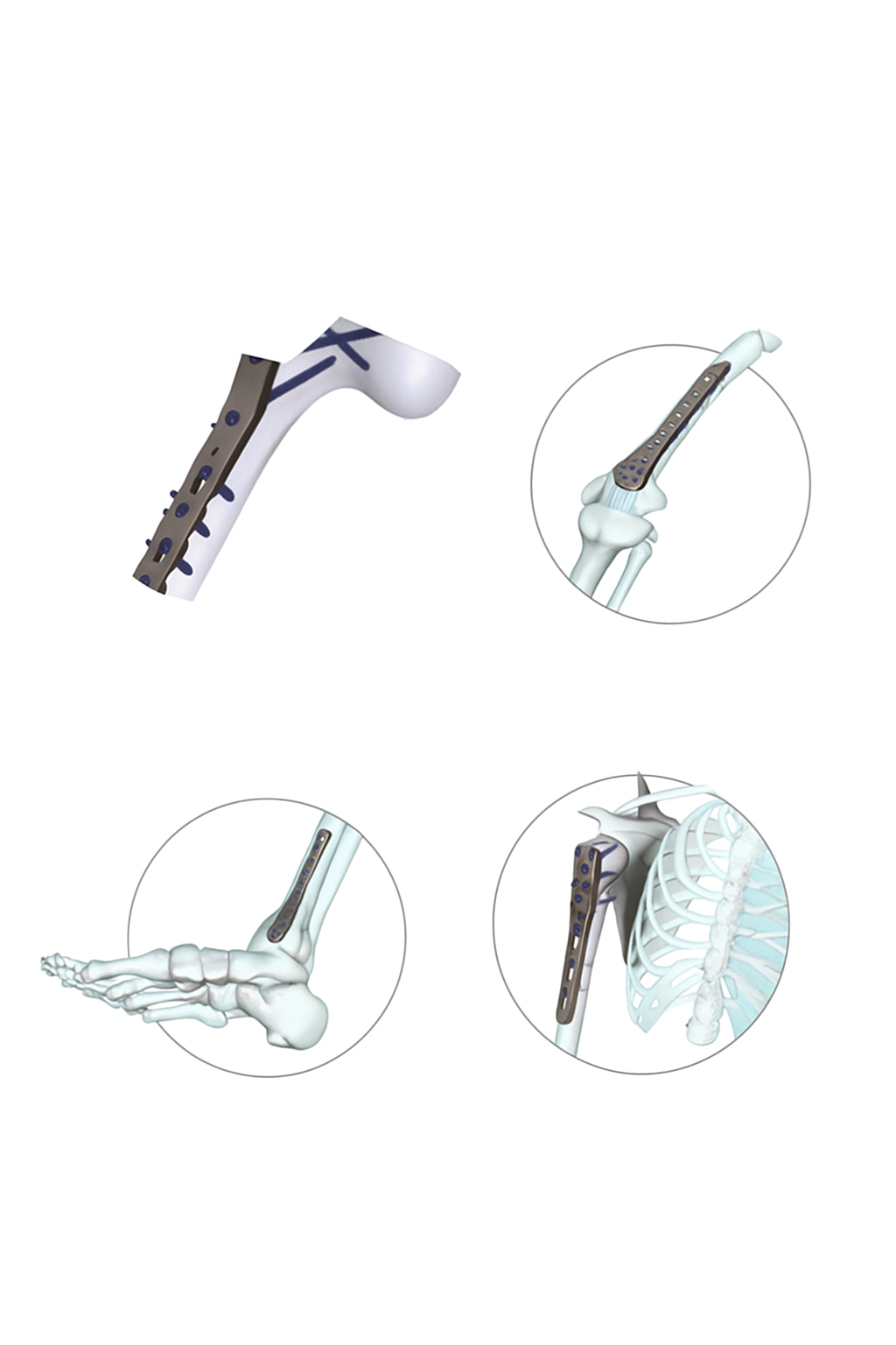 Locking Implants